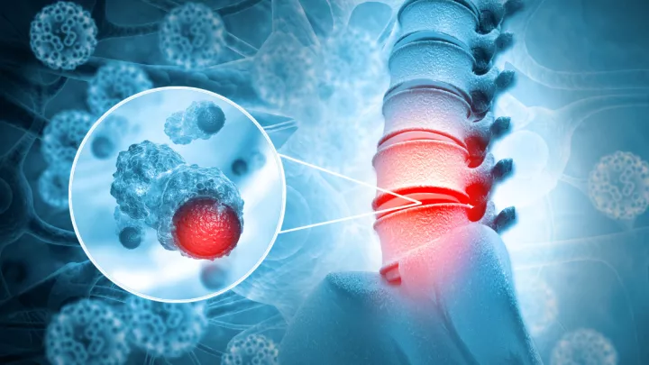 Medical illustration of spine cancer