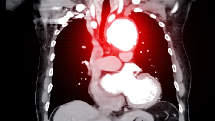 Scan of aortic aneurysm